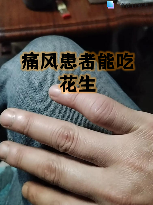 痛风能吃花生豆芽吗