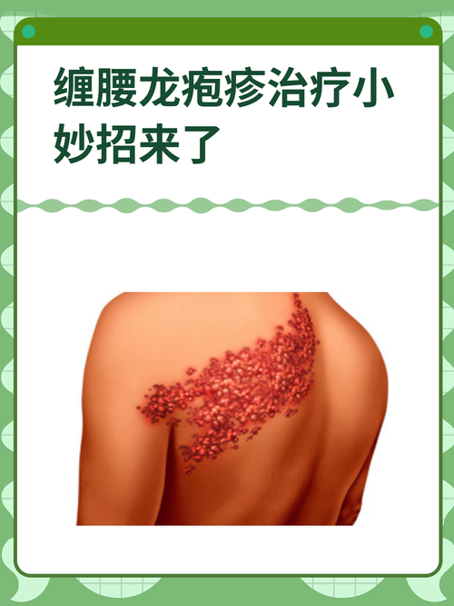 西安治疗疱疹九龙安全