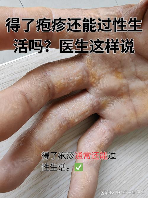 西安治疗疱疹九龙安全