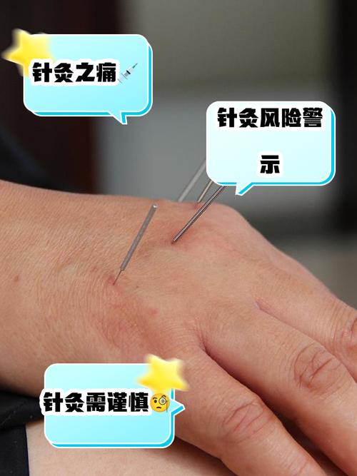 手指腱鞘炎针灸治疗