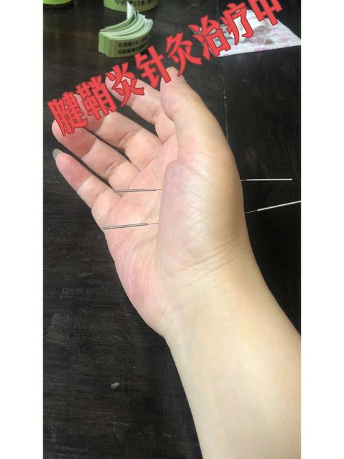 手指腱鞘炎针灸治疗