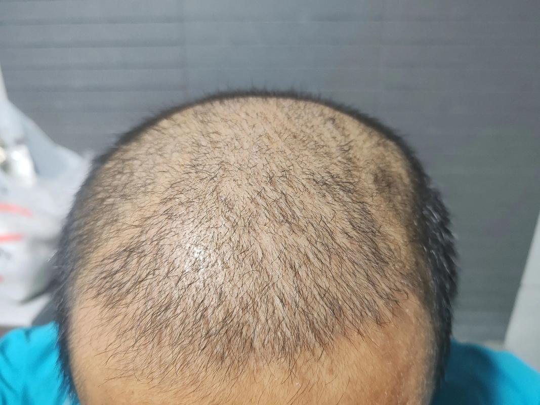 济南植发海峡植发安全