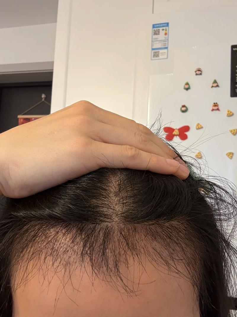 济南植发海峡植发安全