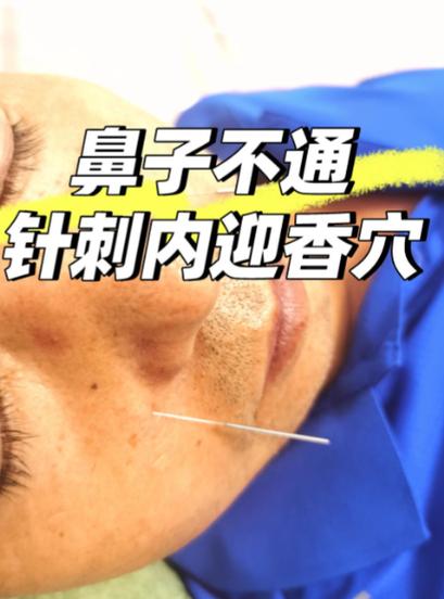 鼻炎做针灸有效果吗