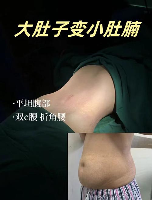 吸脂减肥最安全的医院