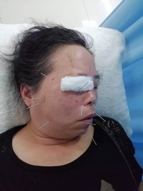 针灸能不能治疗面瘫