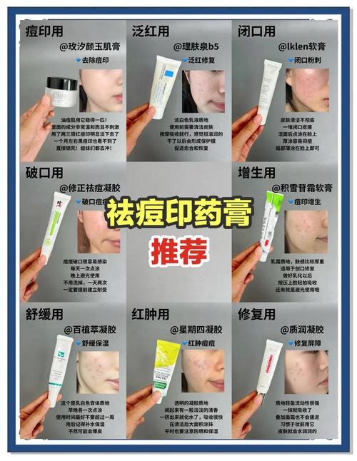 祛痘药膏哪个安全有效
