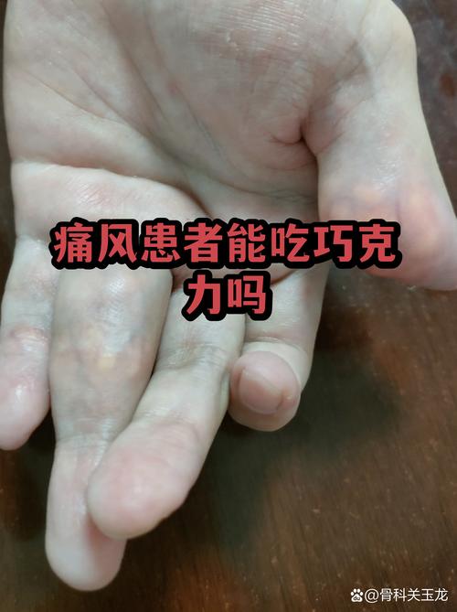 痛风病人能要孩子吗