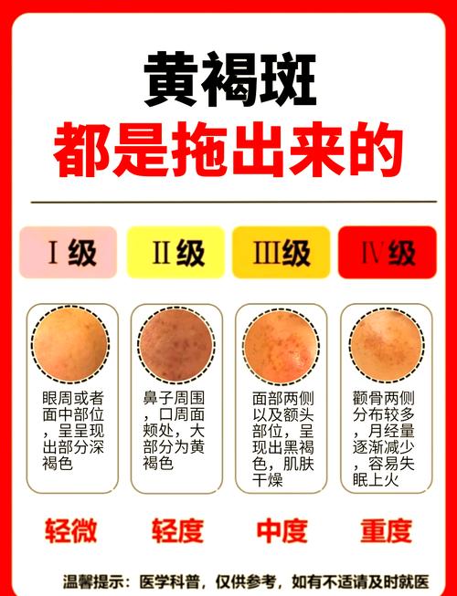 怎样袪斑最有效最安全