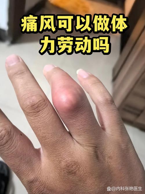 痛风发作能要孩子吗
