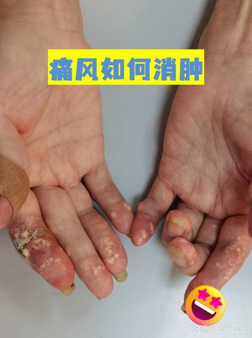 痛风发作时能洗澡么