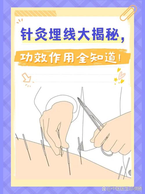 针灸埋线有什么好处