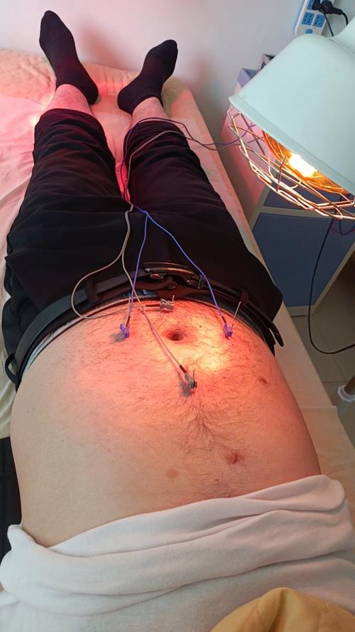 湿气重针灸有效果吗