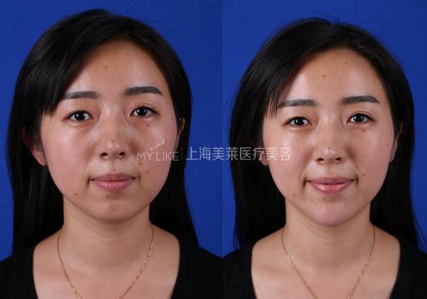 冷光美白上海美莱安全