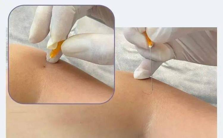 温岭那里有针灸埋线