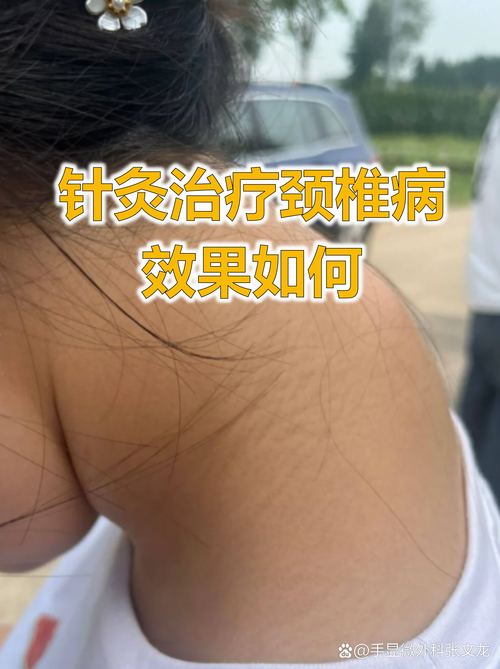 颈椎疼针灸有效果吗