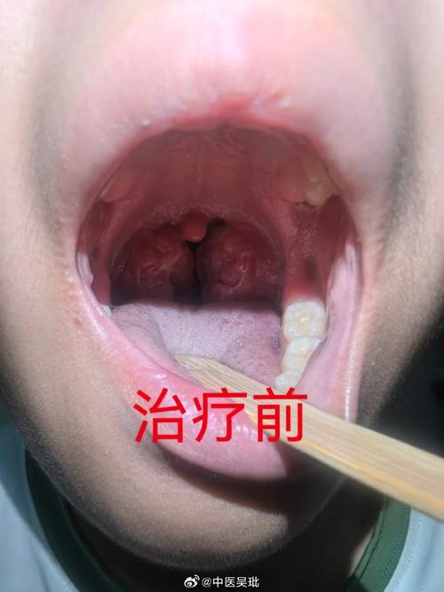 针灸治疗扁桃体肿大