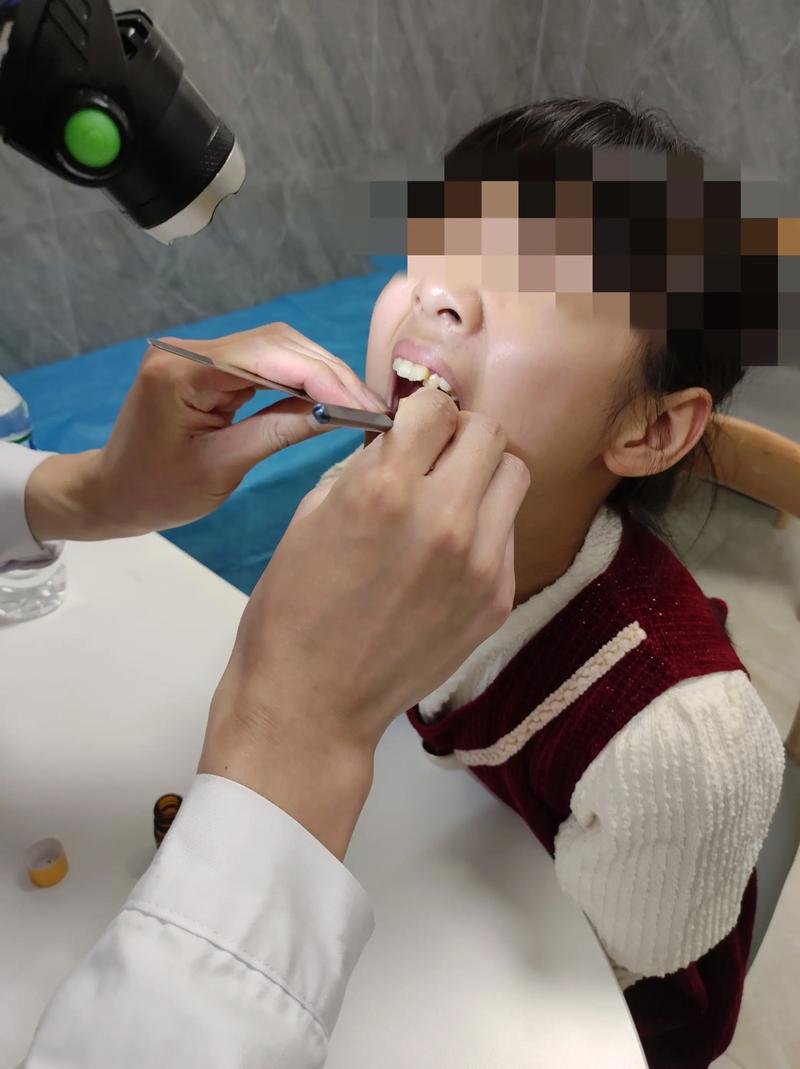 针灸治疗扁桃体肿大