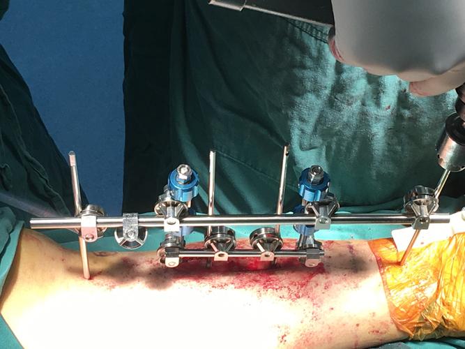 伊里扎洛夫技术安全吗