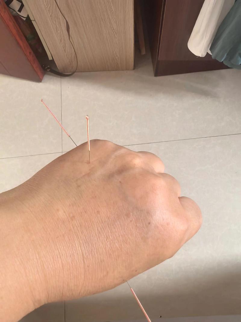 针灸去皱纹留针多久