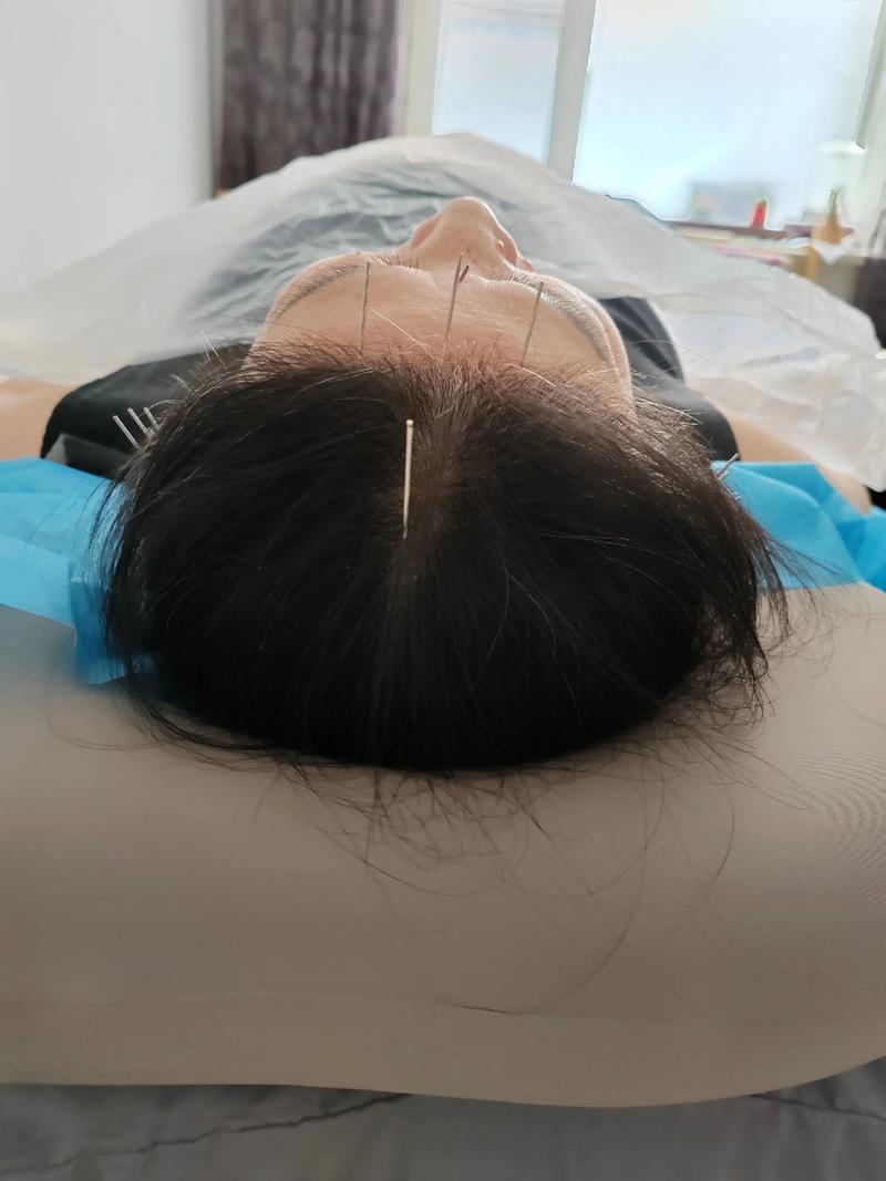 醴陵哪里有做针灸的