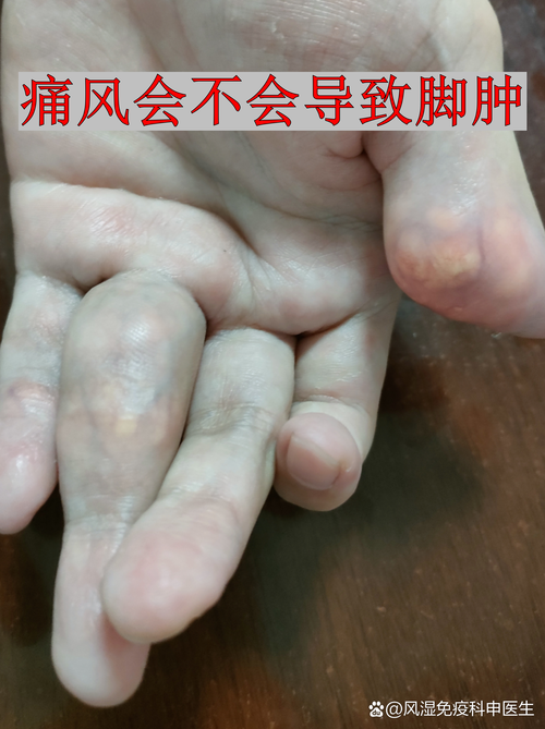痛风脚肿能泡热水吗