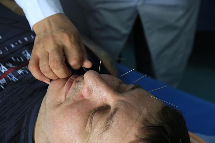 面瘫急性期针灸治疗