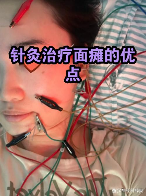 面瘫急性期针灸治疗