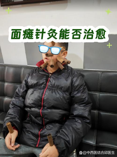 针灸治疗面瘫怎么样