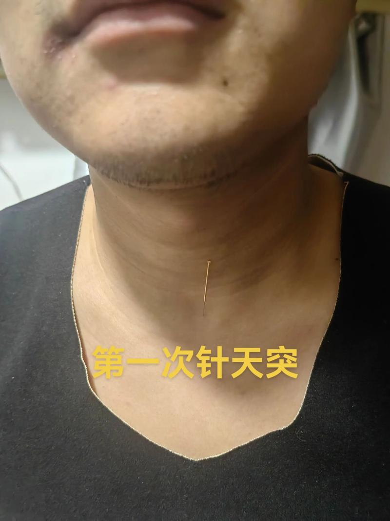 咽喉炎针灸几天可好