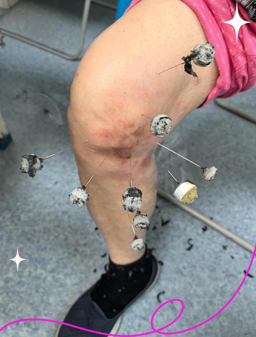 针灸可以治疗的病种