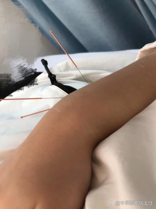 扁桃体化脓针灸哪里