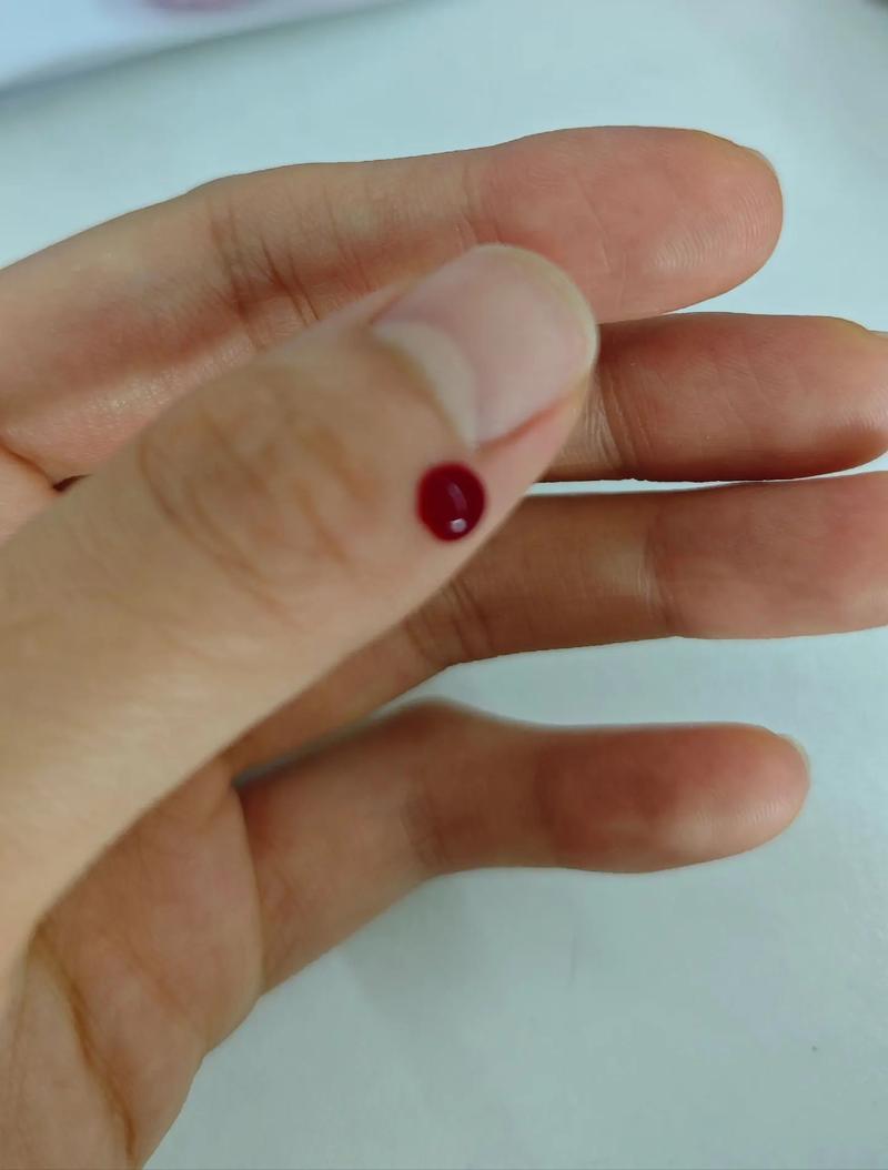 扁桃体化脓针灸哪里