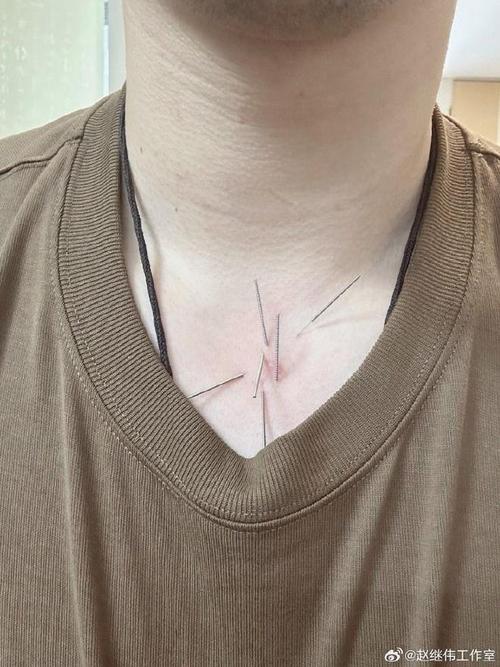 扁桃体化脓针灸哪里