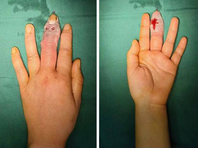 化脓性关节炎 痛风