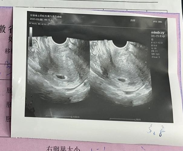 移植十九天是否安全了