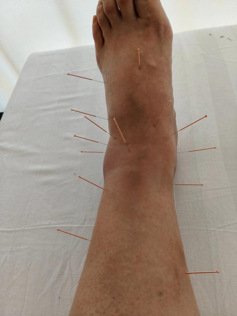 小腿针灸埋线部位肿