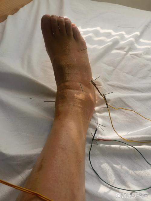 扭伤脚踝针灸治疗吗