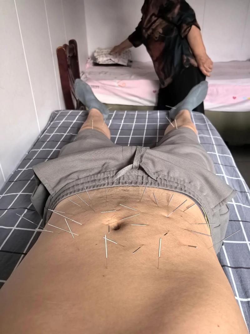 针灸治疗急性肠胃炎