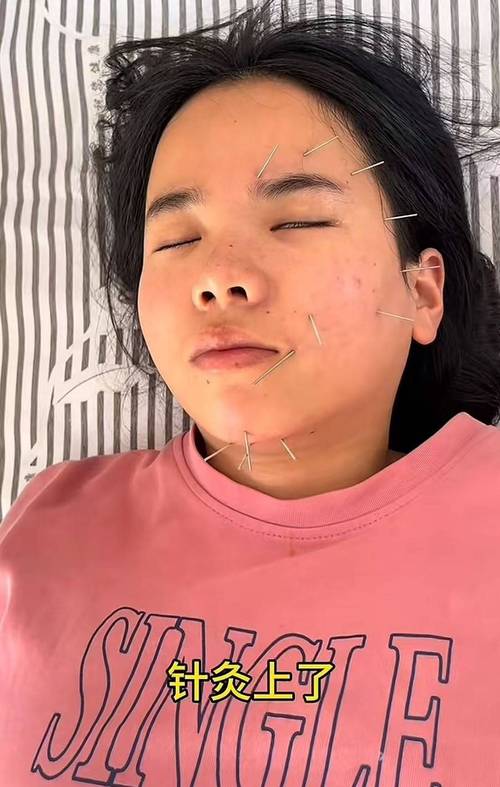 针灸治疗风热型面瘫