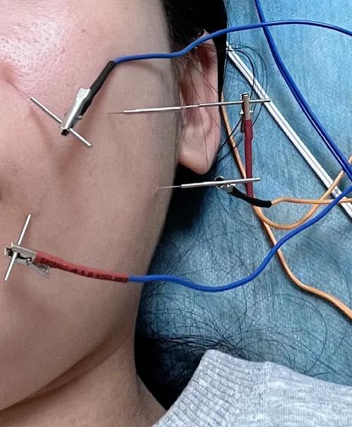 针灸治疗风热型面瘫