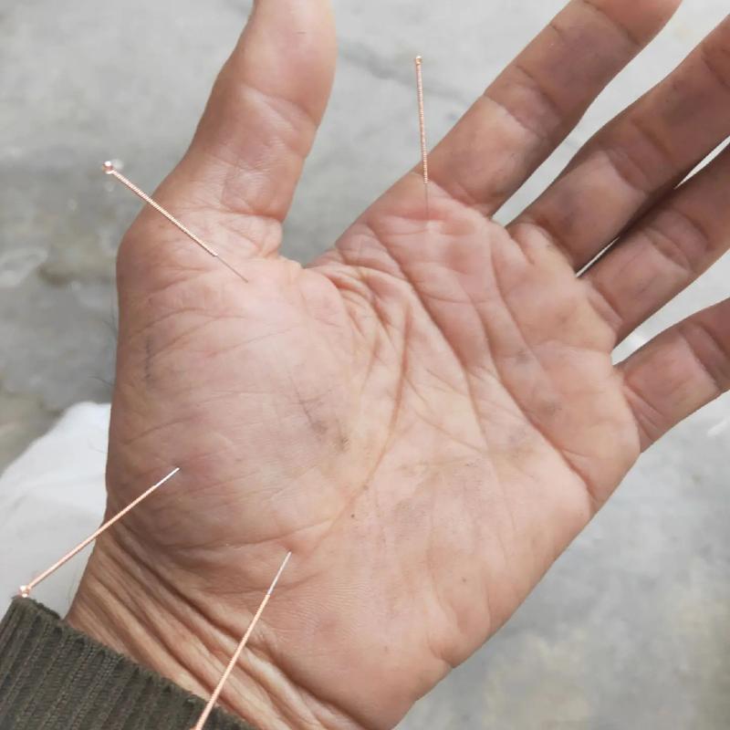 手心针灸是治什么病