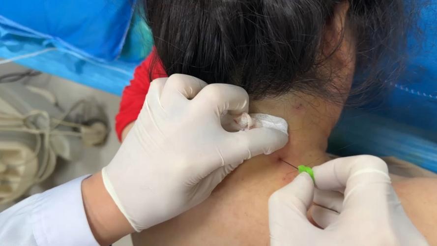 针灸治疗颈椎增生症