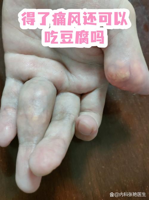痛风病人能吃豆腐么