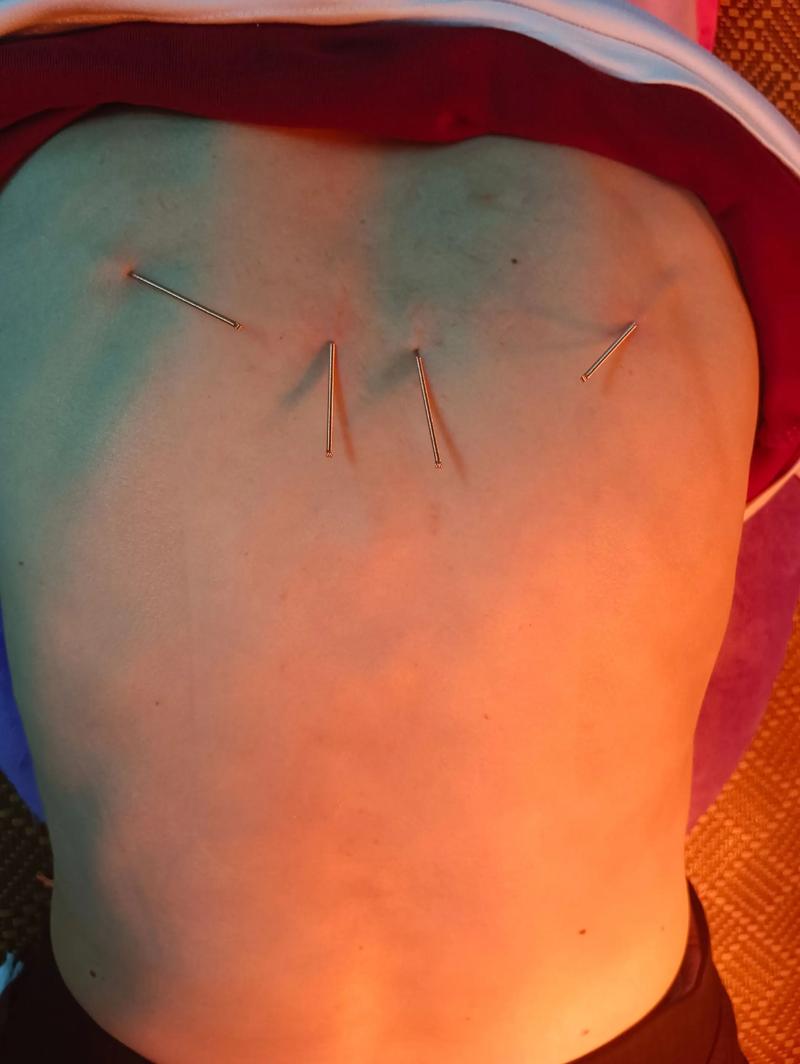 针灸过后胸闷怎么办