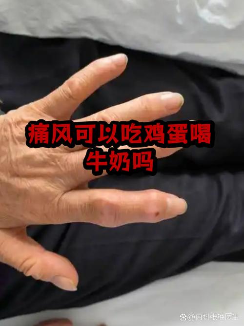 乳酸菌痛风可以吃吗