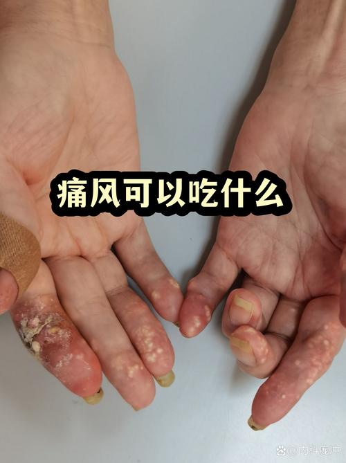 乳酸菌痛风可以吃吗