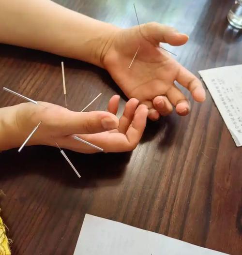 月经量多可以针灸吗