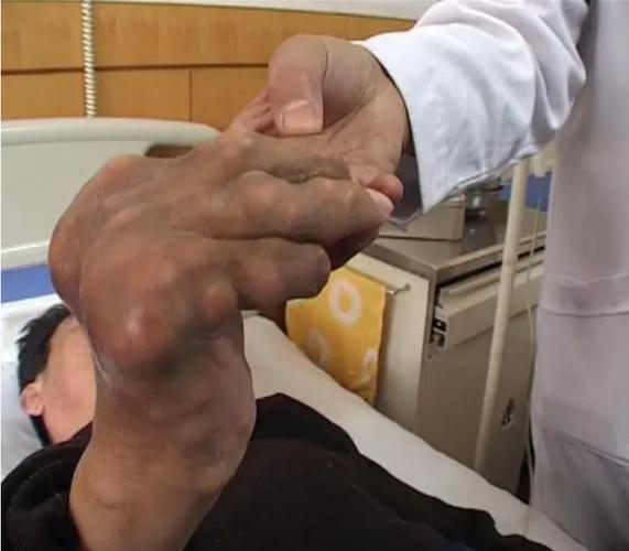 四妙勇安汤治疗痛风