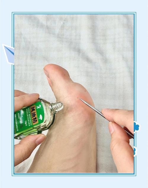 针灸能够治疗跖疣吗